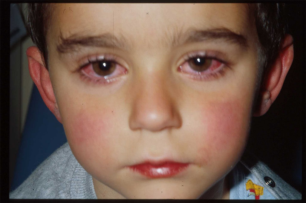 child_Sore_eyes