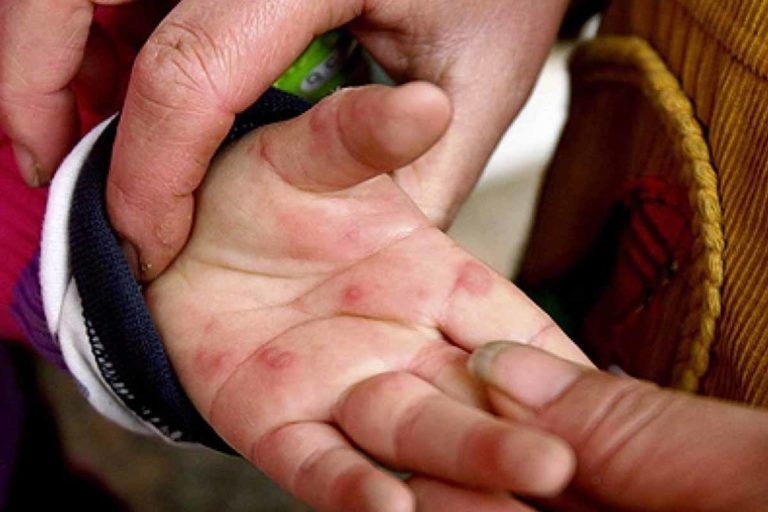 Hand-foot and Mouth Disease